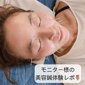You are currently viewing モニターさまの美容鍼体験3