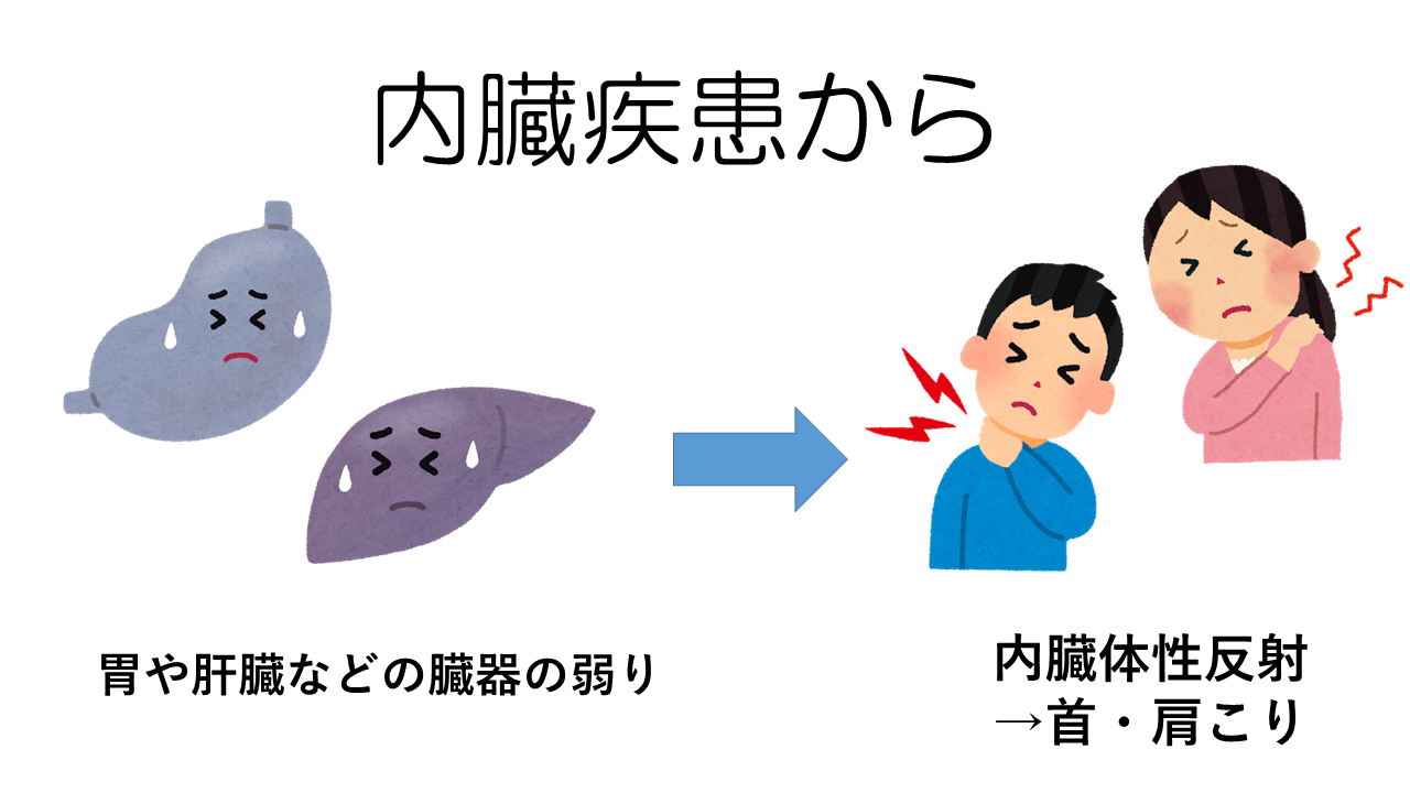 内臓疾患からくる首肩こりタイプ
