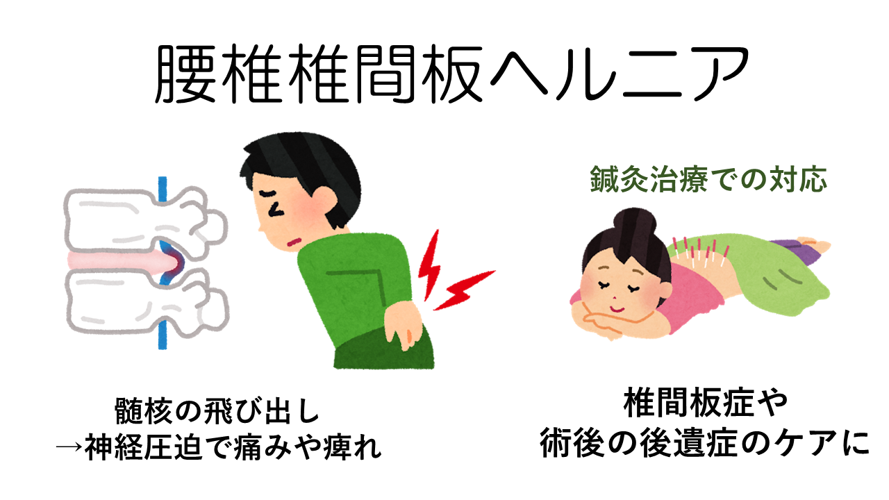 腰椎椎間板ヘルニア