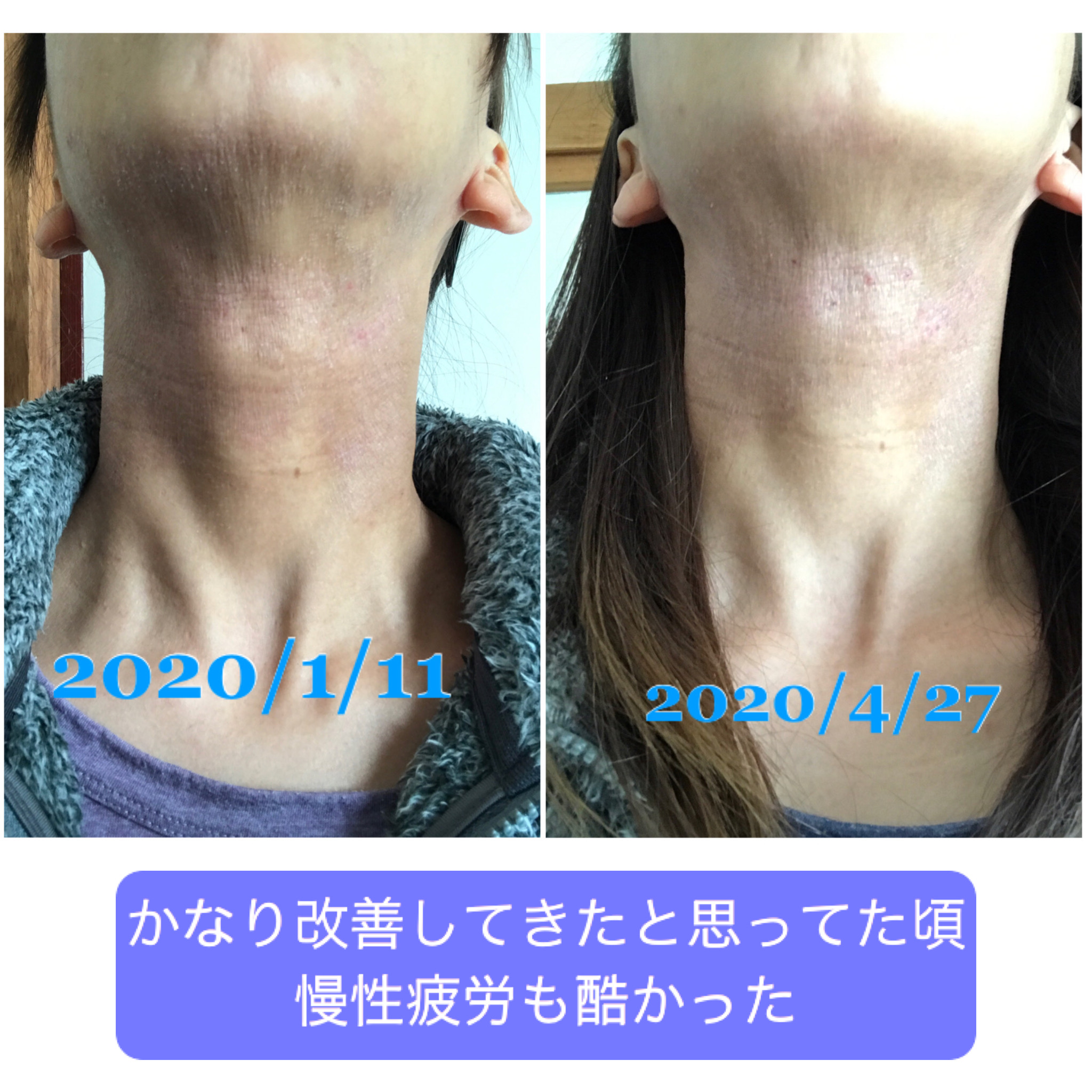 アトピー改善記録