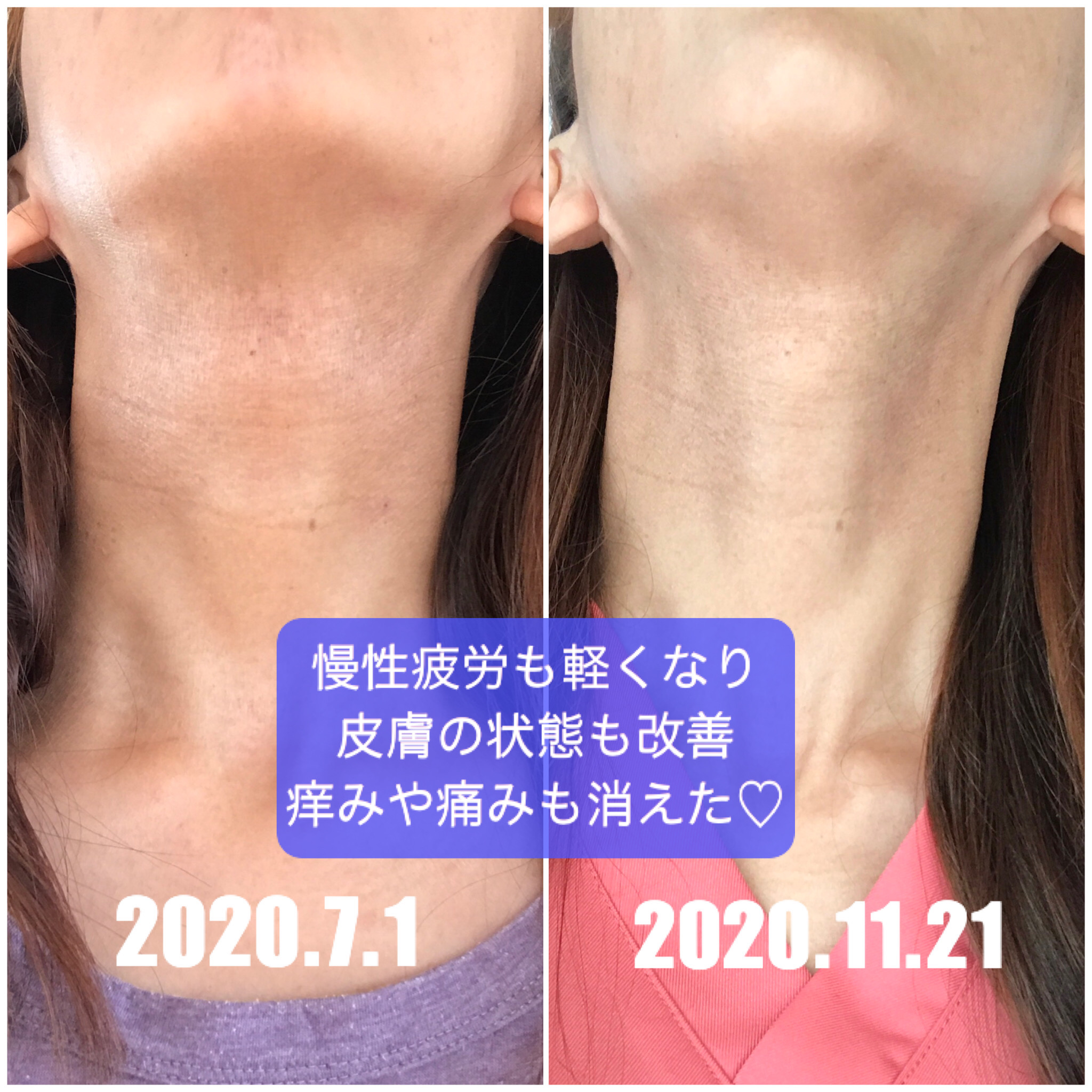 アトピー改善記録2