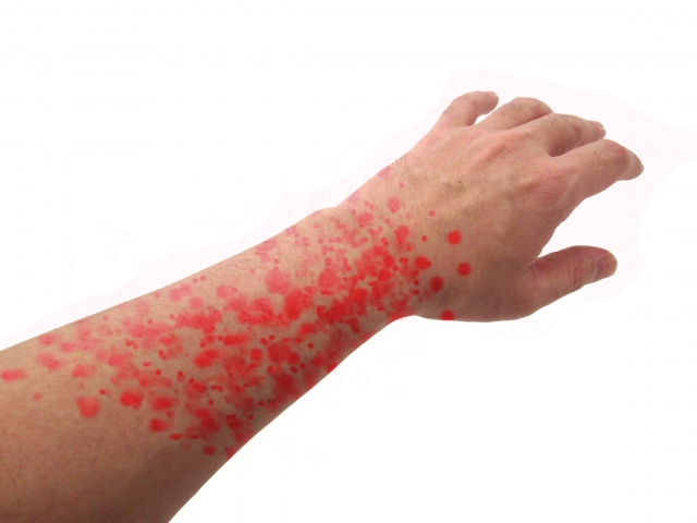 関節に蕁麻疹が出る