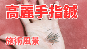 Read more about the article 【施術風景動画】高麗手指鍼（手の鍼）