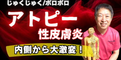 【症例】アトピー性皮膚炎｜脱ステロイド併用