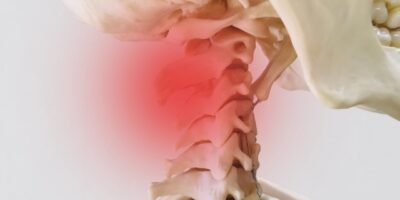 【症例】頸椎捻挫-急性の首痛